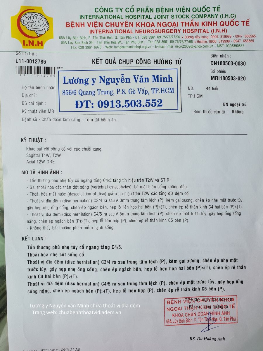 Thoát vị đĩa đệm cổ